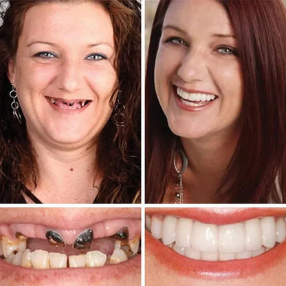 Ends Today: 70% OFF!  🏆2026 Bestselling Product🦷 Fit for a Fresh Smile, Say Goodbye to Wearing Discomfort!🌎